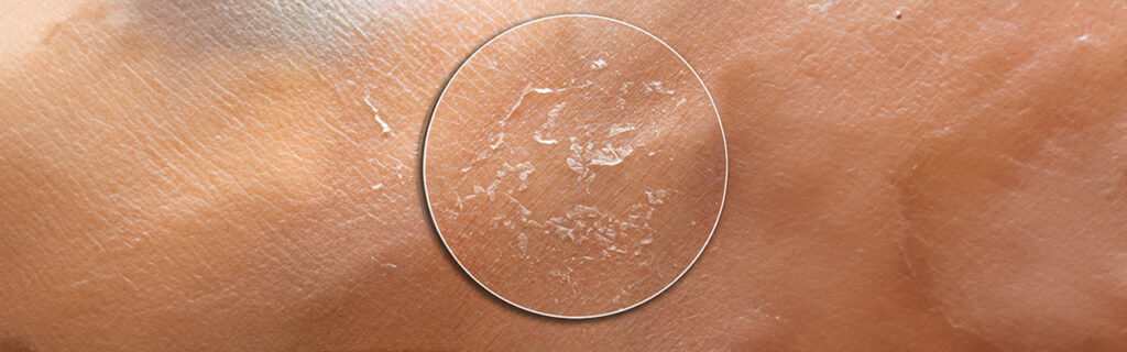 Why Your Skin Gets So Dry in Winter and What to Do About It