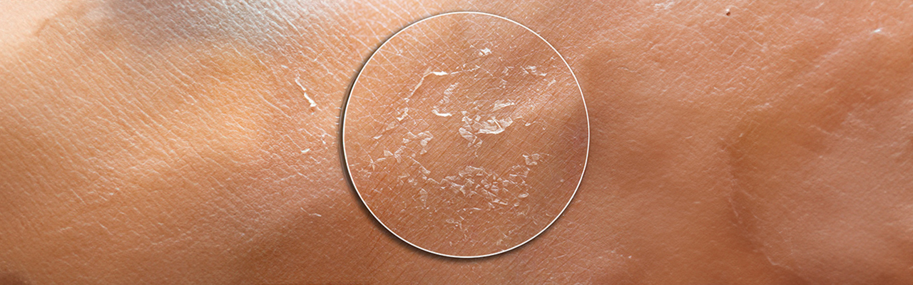 Why Your Skin Gets So Dry in Winter and What to Do About It