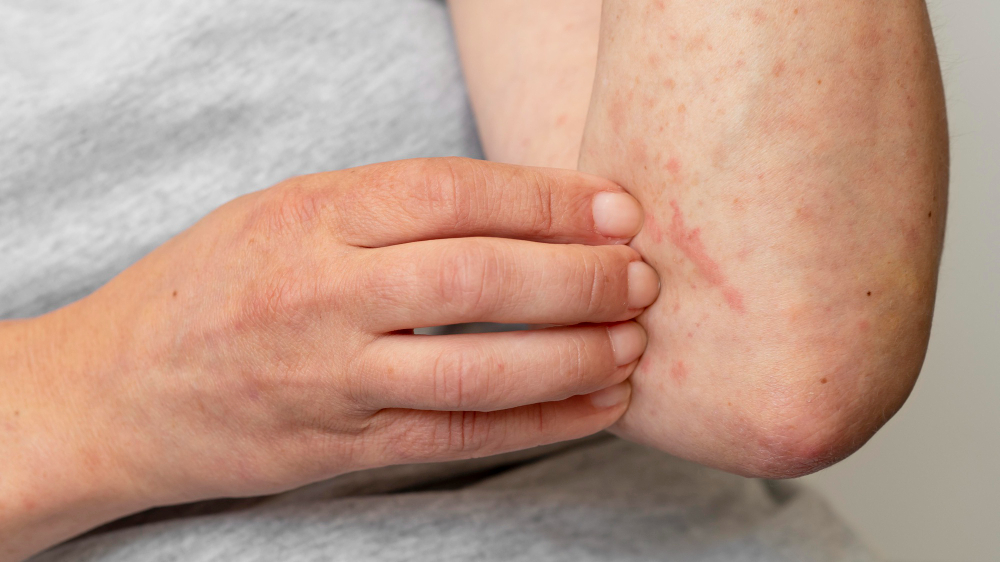 eczema skin hayshine blog