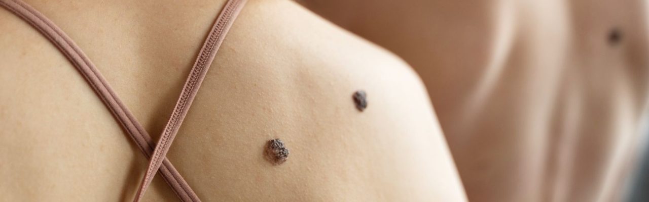 Safe and Painless Methods for Skin Tags Removal